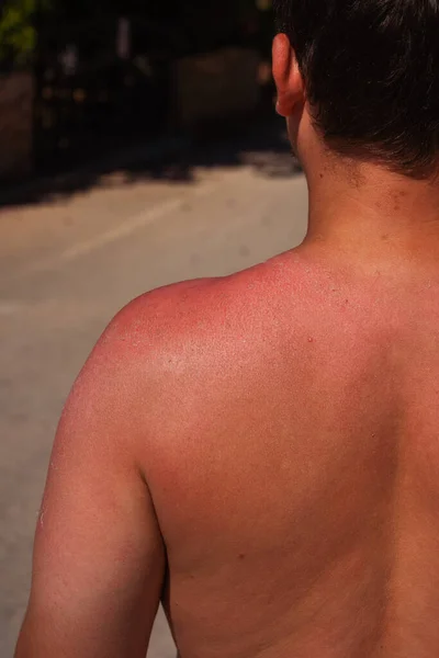 guy with red skin from the sun on vacation in turkey. a man with burns on his skin from sunburn in antalya. a man\'s tan at a dangerous hour