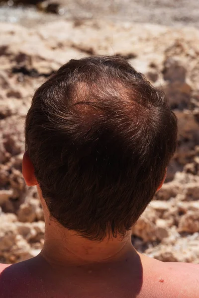 Man Baldness Beach Turkey Guy Shirt Falling Hair Vacation Single — Stock Photo, Image