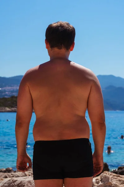 guy with red skin from the sun on vacation in turkey. a man with burns on his skin from sunburn in antalya. a man\'s tan at a dangerous hour