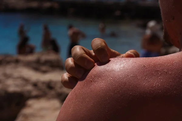 Guy Red Skin Sun Vacation Turkey Man Burns His Skin — Stock Photo, Image