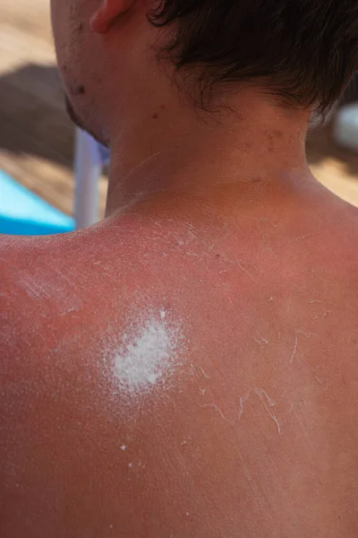 sunburn on the skin of a man. swollen skin from blisters on the boy\'s shoulder. applying protective cream on red skin. white cream to protect the skin in a dangerous hour of sunshine