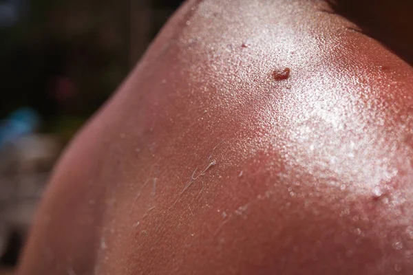 sunburn on the skin of a man. swollen skin from blisters on the boy's shoulder. applying protective cream on red skin. white cream to protect the skin in a dangerous hour of sunshine