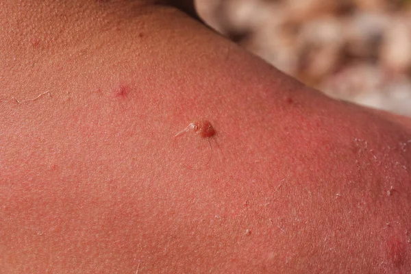 Coups Soleil Sur Peau Homme Peau Gonflée Par Des Ampoules — Photo