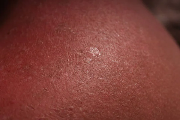 sunburn on the skin of a man. swollen skin from blisters on the boy\'s shoulder. red skin he has an overabundance of sun. sunburn at a dangerous hour