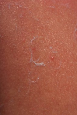 Bir adamın derisinde güneş yanığı. Çocuğun omzundaki kabarcıklar yüzünden şişmiş deri. Kırmızı cilde koruyucu krem sürüyorum. Tehlikeli bir güneş ışığı saatinde deriyi korumak için beyaz krem.