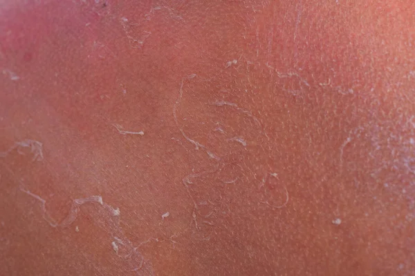 晒伤了一个人的皮肤 男孩肩膀上的水泡使皮肤肿胀 在红皮上涂保护霜 在危险的阳光下保护皮肤的白霜 — 图库照片