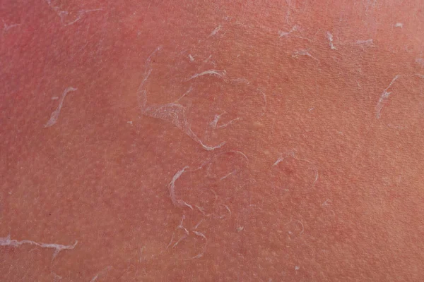 男の肌に日焼け 男の子の肩の水疱から腫れた皮膚 赤い肌に保護クリームを塗ります 太陽の下で肌を守る白いクリーム — ストック写真