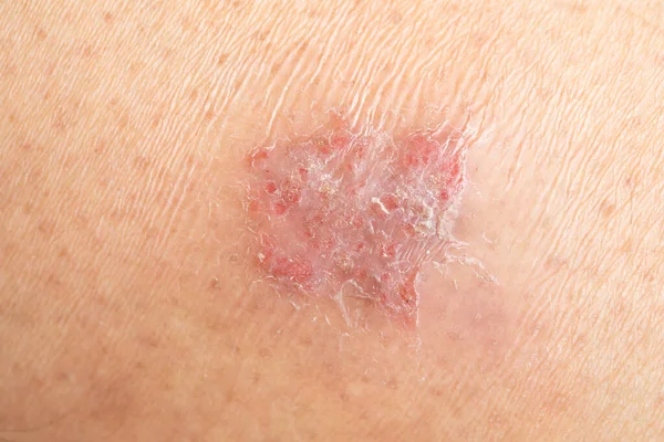 Dermatologisk Hudsjukdom Mänsklig Hud — Stockfoto