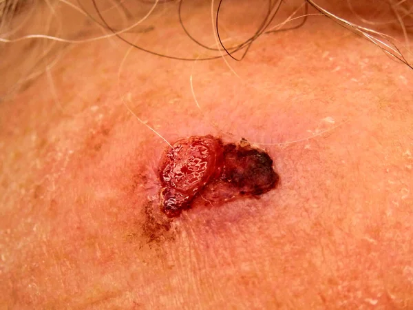 Squamous Cell Carcinoma Forehead Exposure Uva Particularly Sunlight Resulting Need — Photo