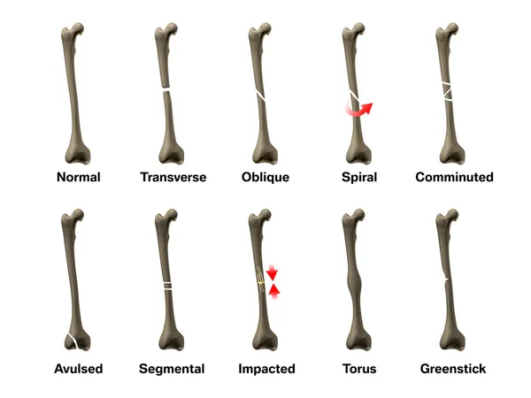 Todos os tipos de fraturas ósseas — Fotografia de Stock