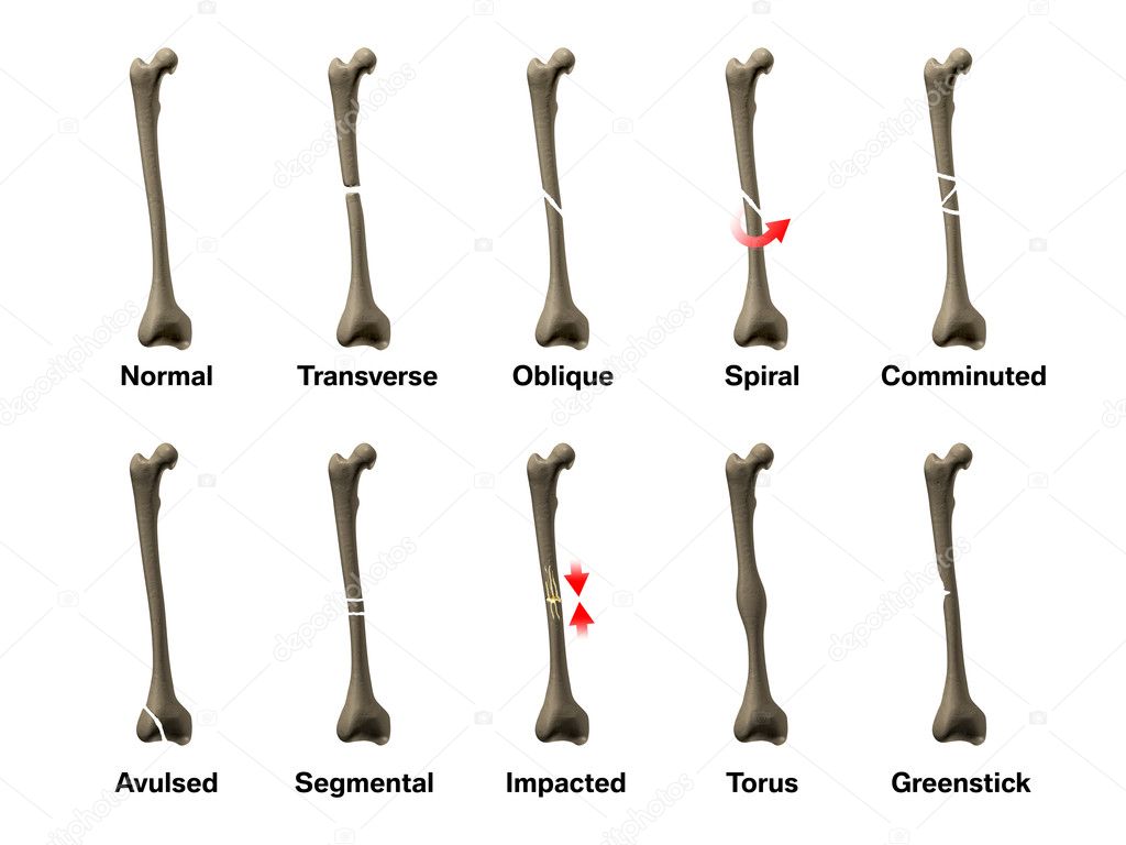 All Types of Bone Fractures