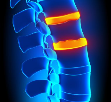 osteophyte oluşumu disk dejenerasyonu - omurga sorunu