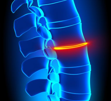 Thinning Disc Degeneration - Spine problem clipart