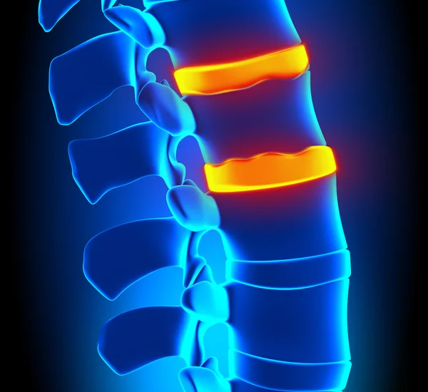 Degeneración de disco de formación osteófita - Problema de columna vertebral —  Fotos de Stock