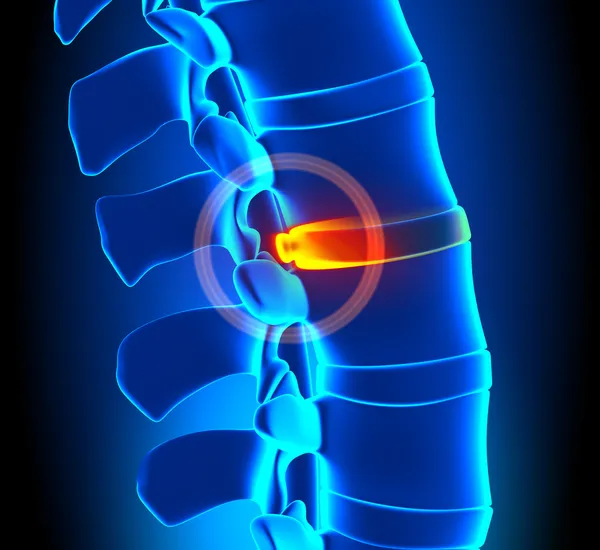 Degeneração Disco Bulging - problema da coluna vertebral — Fotografia de Stock