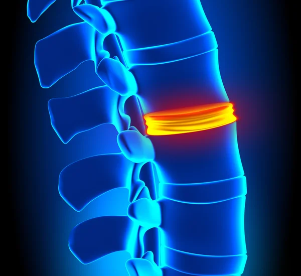 Degeneración de disco - Problema de columna vertebral — Foto de Stock