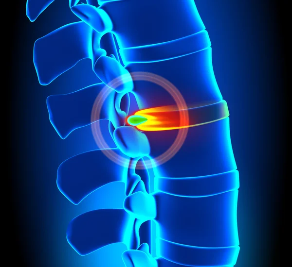 Herniated disk degenerace - páteře problém — Stock fotografie