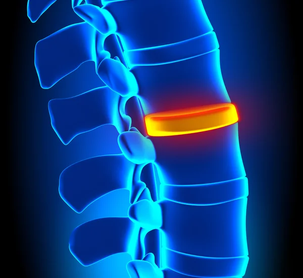 Disc Degeneration - Spine problem — Stock Image Disc Degeneration - Spine problem Stock Image