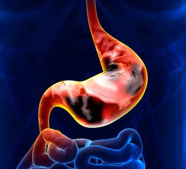 Stomach Cancer clipart