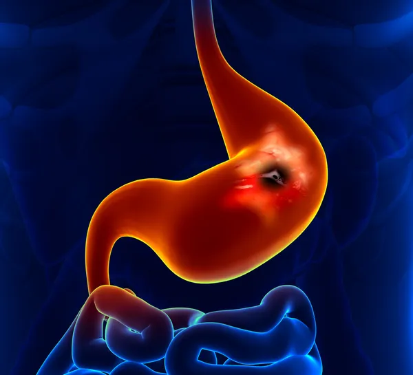 Peptic Ulcer - Stomach problem — Stock Photo, Image