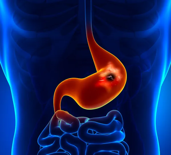 Peptic Ulcer — Stockfoto