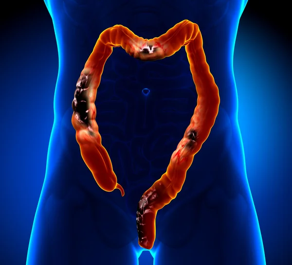 Cancro al colon Cancro colorettale — Foto Stock