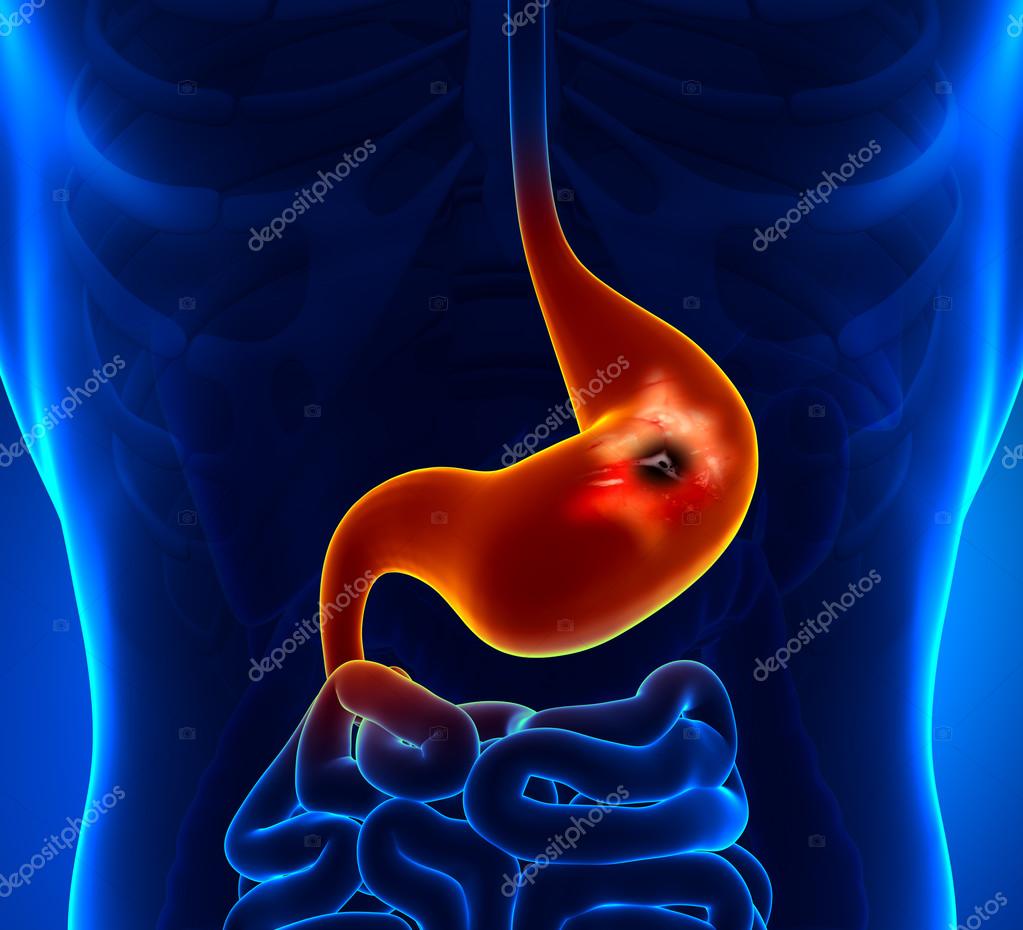 Peptic Ulcer — Stock Photo © decade3d 41030669