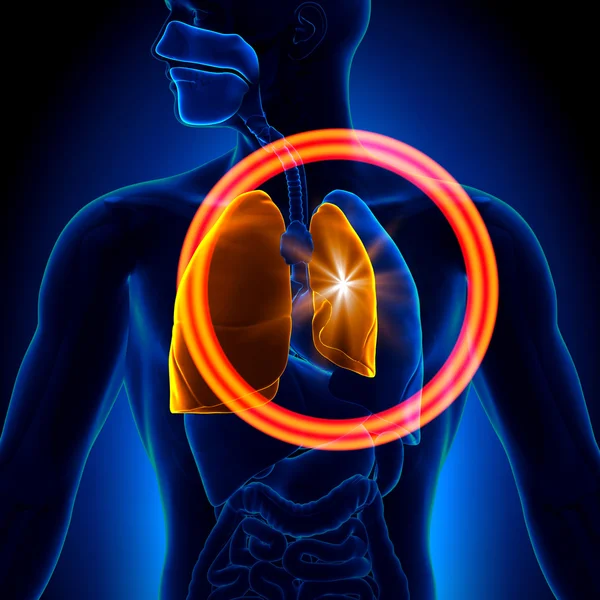 Pnömotoraks - akciğerleri ayrıntılı — Stok fotoğraf