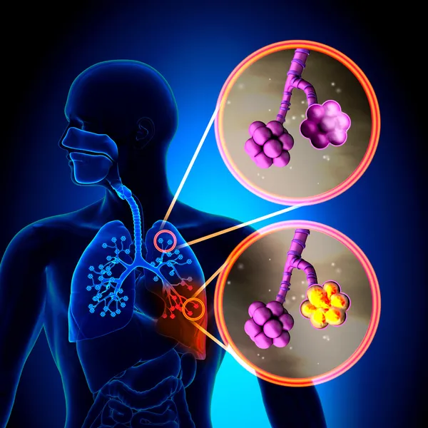 Pneumonia - Alvéolos normais vs Pneumonia — Fotografia de Stock