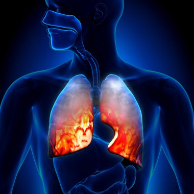 Pneumonia - Lungs Inflammatory Condition clipart