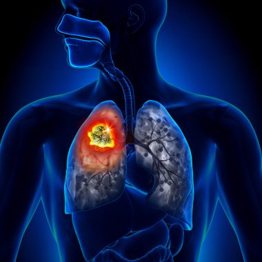 Lung Cancer - Tumor detail clipart