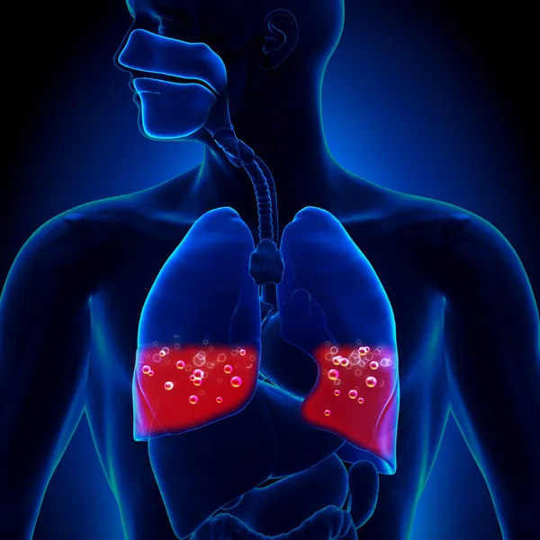 Œdème pulmonaire - Sang dans les poumons — Photo