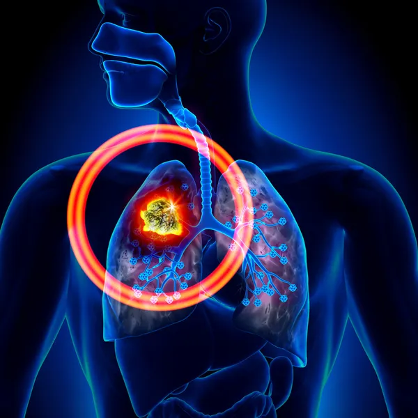 Rak płuc - detal guz — Zdjęcie stockowe