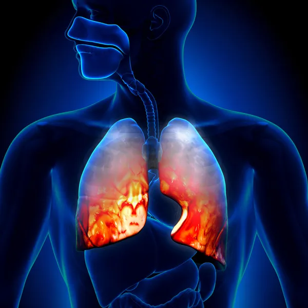 Neumonía: estado inflamatorio de los pulmones — Foto de Stock