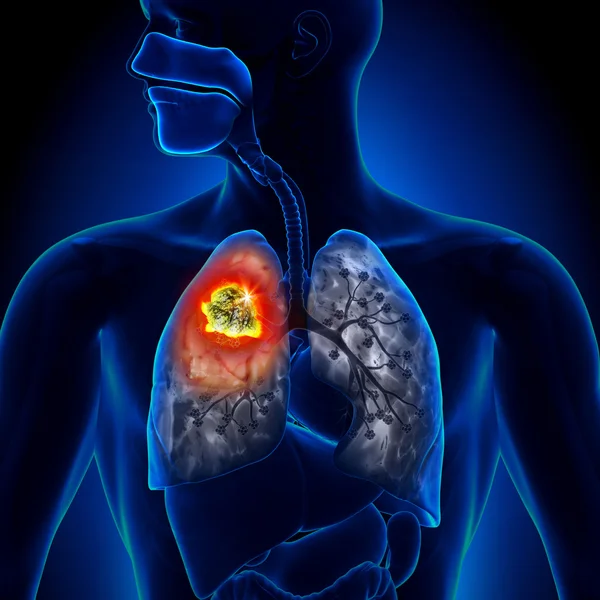 Cancro do Pulmão - Detalhe do tumor — Fotografia de Stock