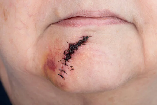 Horizontal Shot Post Surgical Suture Her Lower Lip Her Chin — Stock Photo, Image