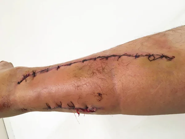 Tiefe Schnittwunde Bein Genäht Mit Einer Chirurgischen Naht Für Medizin Stockfoto