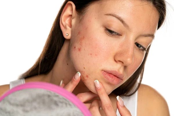 Young Beautiful Woman Squeezes Pimples Her Cheek White Background — Stock Photo, Image