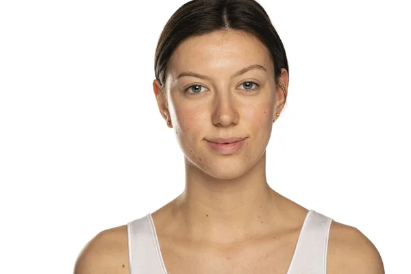 Piękna Uśmiechnięta Kobieta Bez Makijażu Problematycznej Skóry Białym Tle — Zdjęcie stockowe