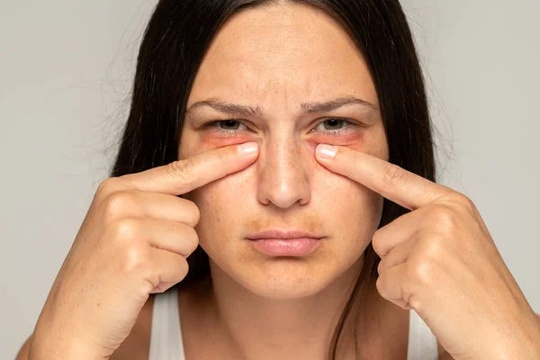 Young Unhappy Woman Touches Her Undereyes Gray Background — Stock Photo, Image