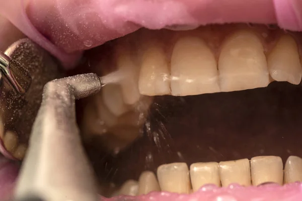 Closeup Teeth Sandblasting Tartar Cleaning Whitening — Stock Photo, Image
