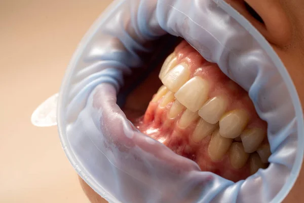 Primer Plano Del Abrelatas Goma Paciente Consultorio Dental — Foto de Stock