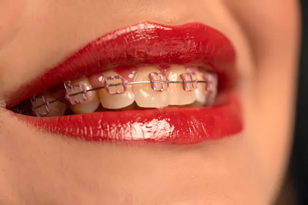 Zbliżenie Samica Uśmiech Usta Protezami — Zdjęcie stockowe