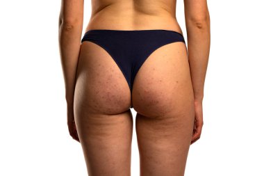 Beyaz arka planda, sorunlu cilt, sivilce ve selülit izole edilmiş kadın kalçaları.