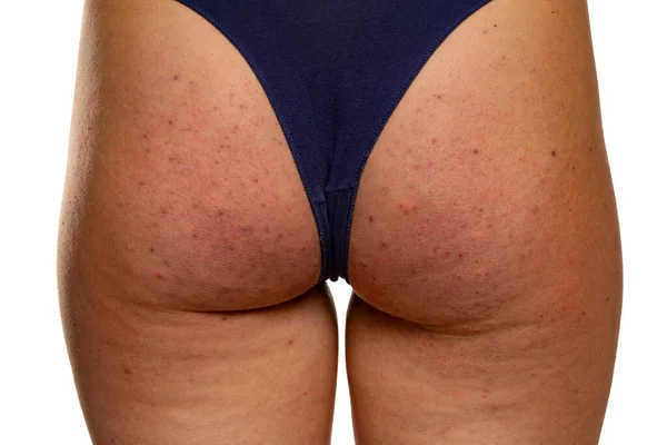 Γλουτούς Της Γυναίκας Προβληματικό Δέρμα Και Σπυράκια Close Απομονώνονται Λευκό — Φωτογραφία Αρχείου