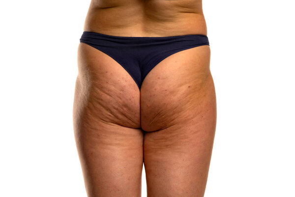 woman's buttocks with problematic skin and pimples and cellulite isolated on white background