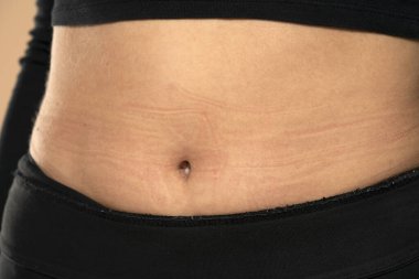 Bir kadının karnındaki iç çamaşırından çıkan deri girintileri. Yakın çekim