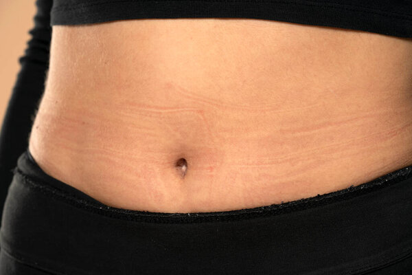 skin indents from underwear on a woman's belly. closeup