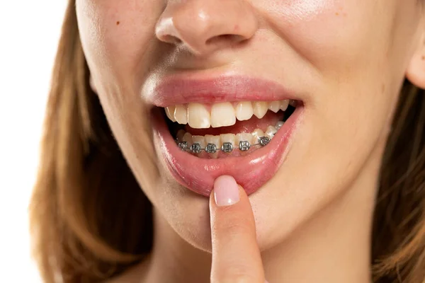 Kobieta Pokazuje Protezę Dolnych Zębach Zamknij Się — Zdjęcie stockowe
