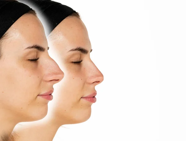 Porównanie Kobiecego Nosa Przed Operacji Plastycznej Białym Tle — Zdjęcie stockowe